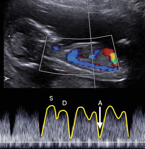 doppler maternaler gefäße|Doppler ultrasound in obstetrics